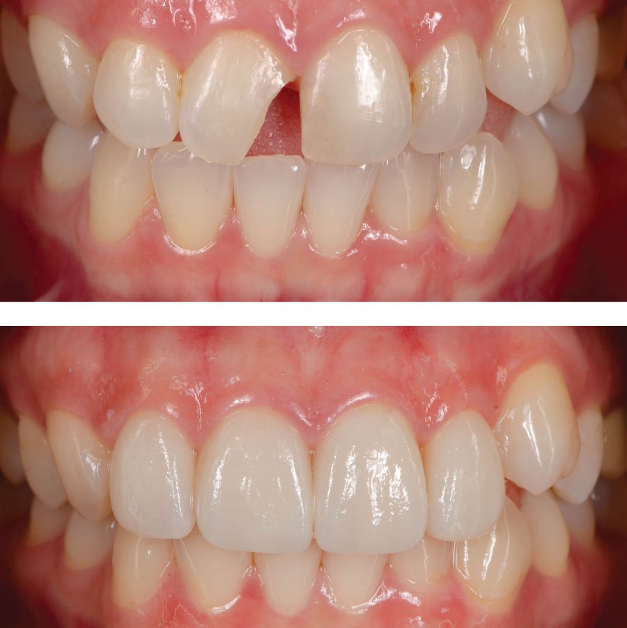 Emergency Dentists in Kirkland Before and After