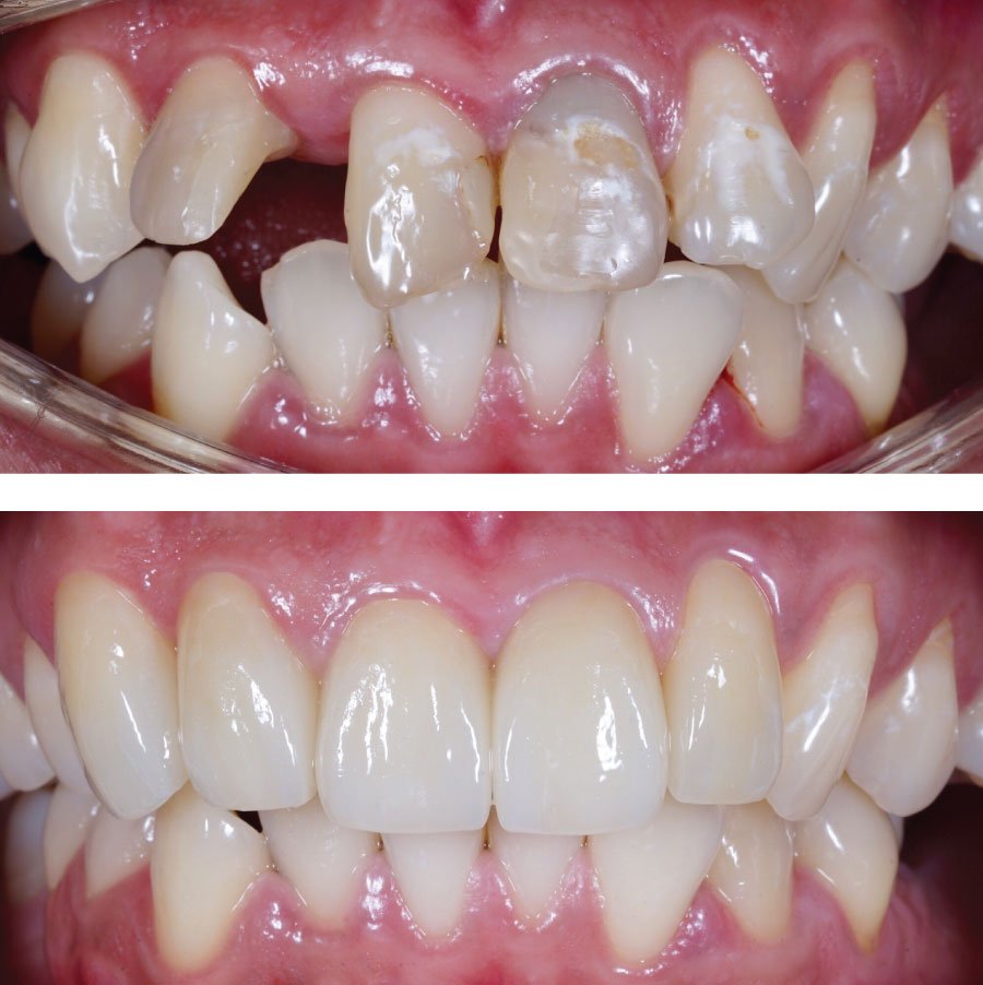 Emergency Dentists in Kirkland Before and After