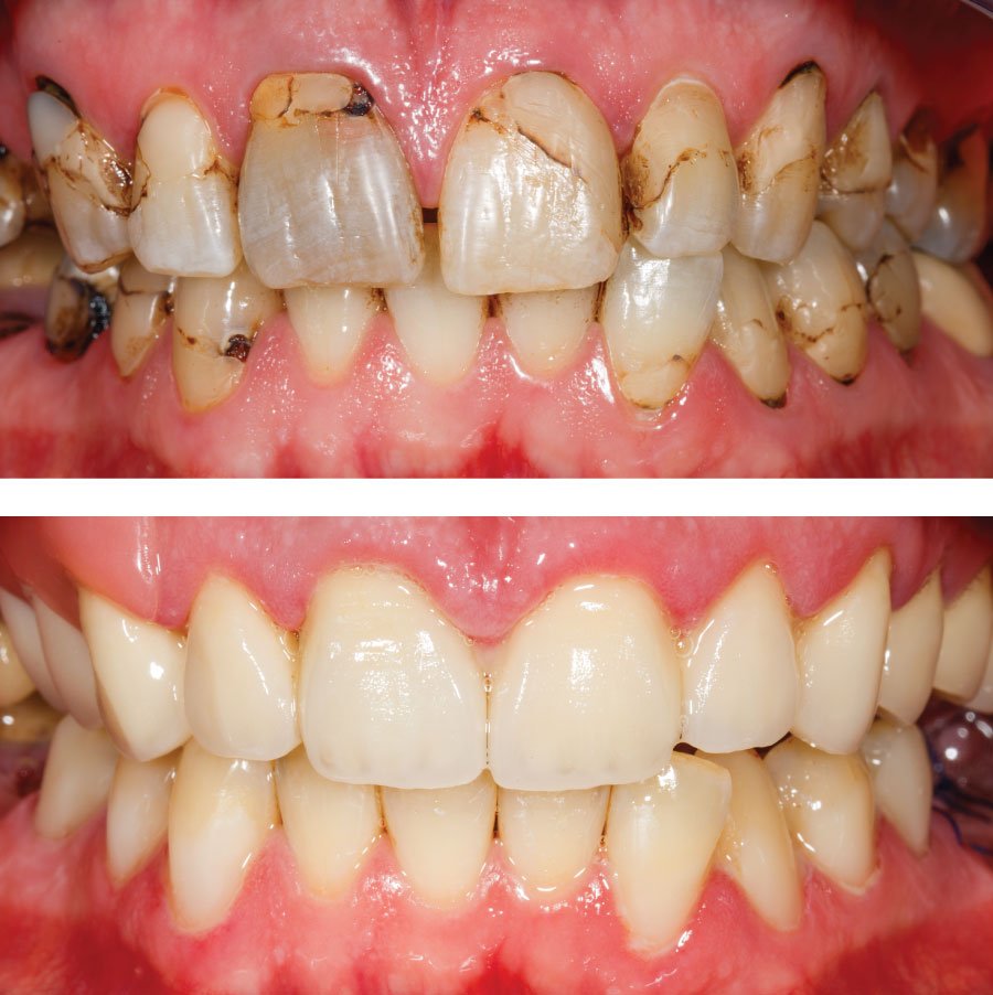Emergency Dentists in Kirkland Before and After