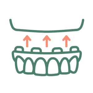 All-on-4 Dental Implants