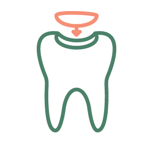 Dental Fillings