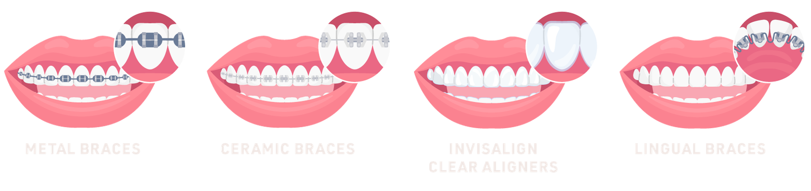 Types of Braces