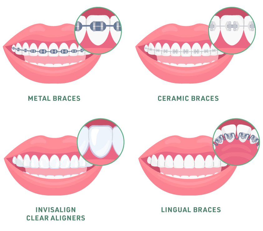 Types of Braces