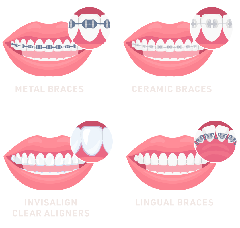 Types of Braces