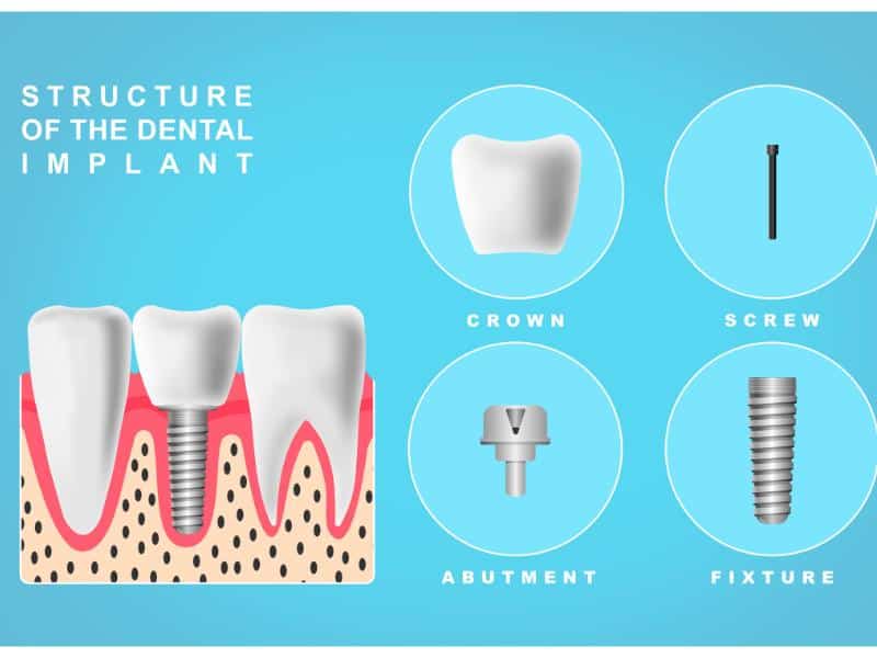 Illustration showing the structure of a dental implant