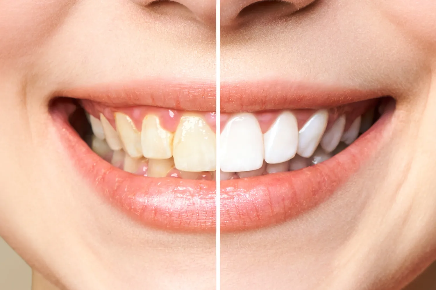 Before and after Teeth whitening in Kirkland, WA, comparison.