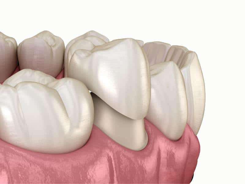 Example of dental crowns placed by our Kirkland cosmetic dentists