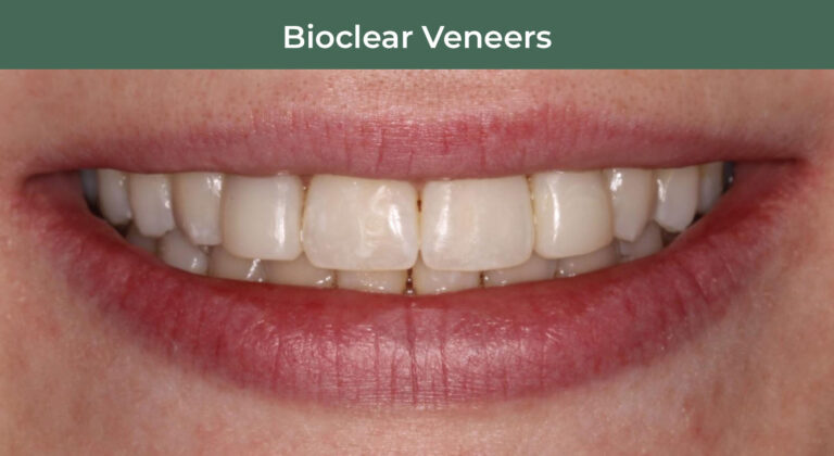 After BioClear Veneers at Manson & Chi Dentistry in Kirkland, WA