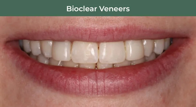 After BioClear Veneers at Manson & Chi Dentistry in Kirkland, WA