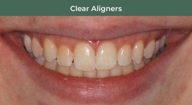 After clear aligners at Manson & Chi Dentistry in Kirkland, WA