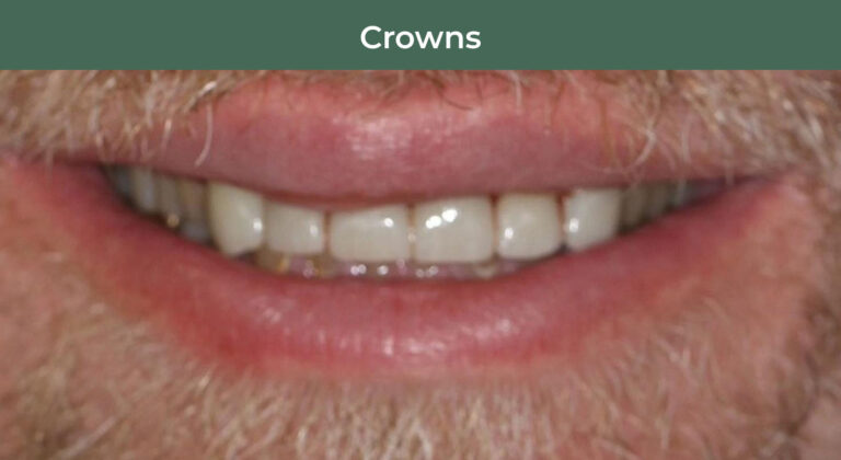 After dental crowns at Manson & Chi Dentistry in Kirkland, WA
