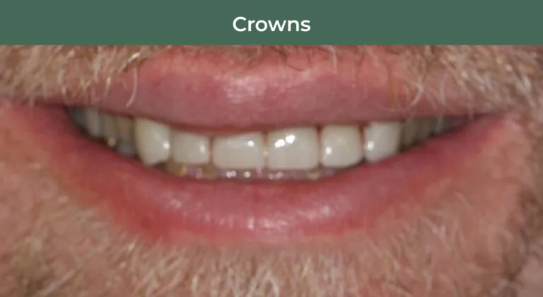 After dental crowns at Manson & Chi Dentistry in Kirkland, WA