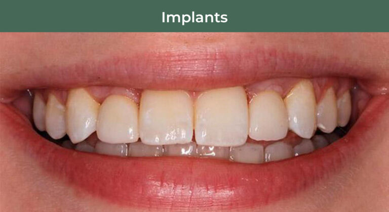 After dental implants at Manson & Chi Dentistry in Kirkland, WA