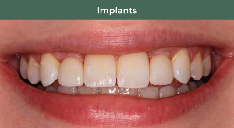 After dental implants at Manson & Chi Dentistry in Kirkland, WA