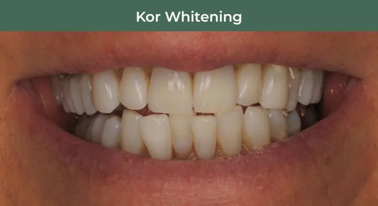 After KOR Teeth Whitening at Manson & Chi Dentistry in Kirkland, WA