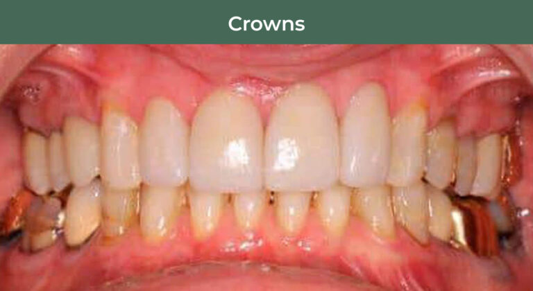 After Anterior Dental Crowns at Manson & Chi Dentistry in Kirkland, WA