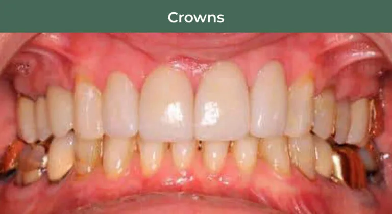 After Anterior Dental Crowns at Manson & Chi Dentistry in Kirkland, WA