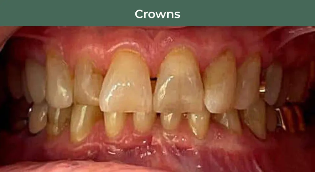 Before Anterior Dental Crowns at Manson & Chi Dentistry in Kirkland, WA