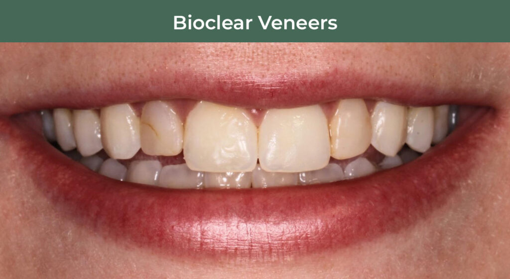 Before BioClear Veneers at Manson & Chi Dentistry in Kirkland, WA