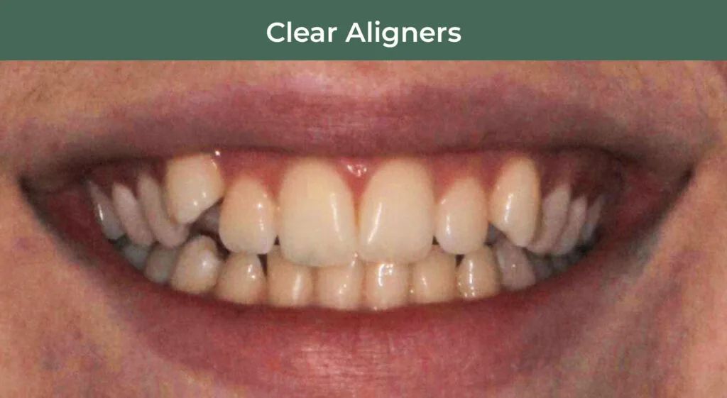 Before clear aligners at Manson & Chi Dentistry in Kirkland, WA