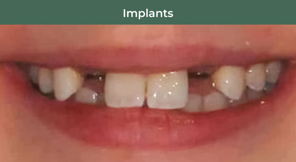 Before dental implants at Manson & Chi Dentistry in Kirkland, WA