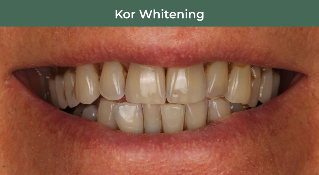 Before KOR Teeth Whitening at Manson & Chi Dentistry in Kirkland, WA