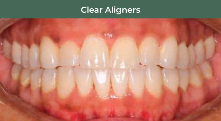 After clear aligner treatment at Manson & Chi Dentistry in Kirkland, WA
