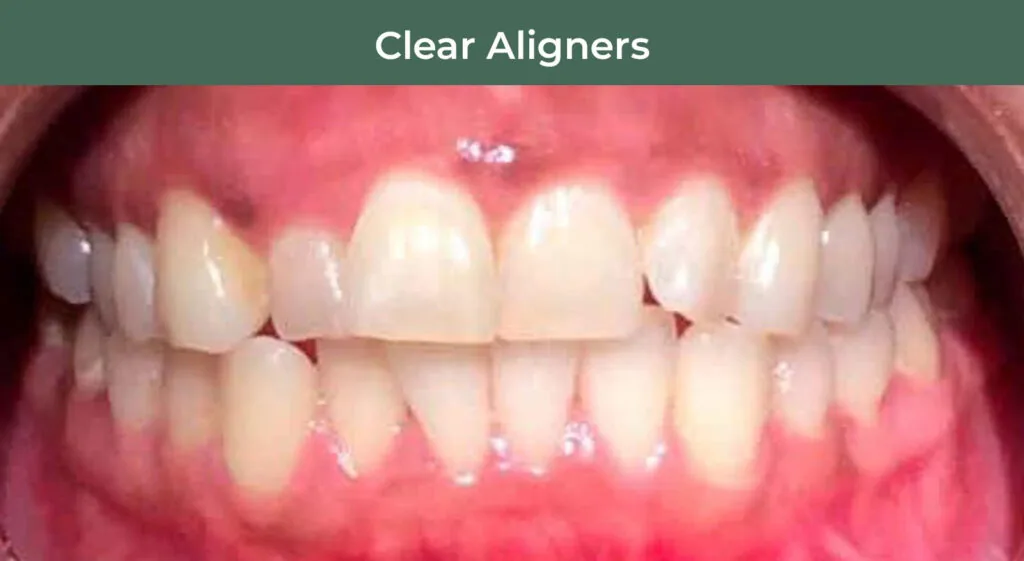Before clear aligner treatment at Manson & Chi Dentistry in Kirkland, WA
