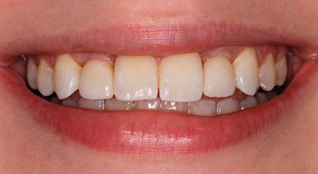 After dental implants at Manson & Chi Dentistry in Kirkland, WA