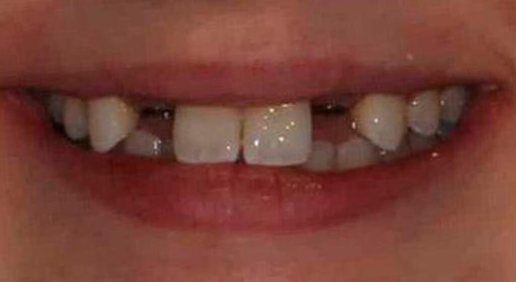 Before dental implants at Manson & Chi Dentistry in Kirkland, WA