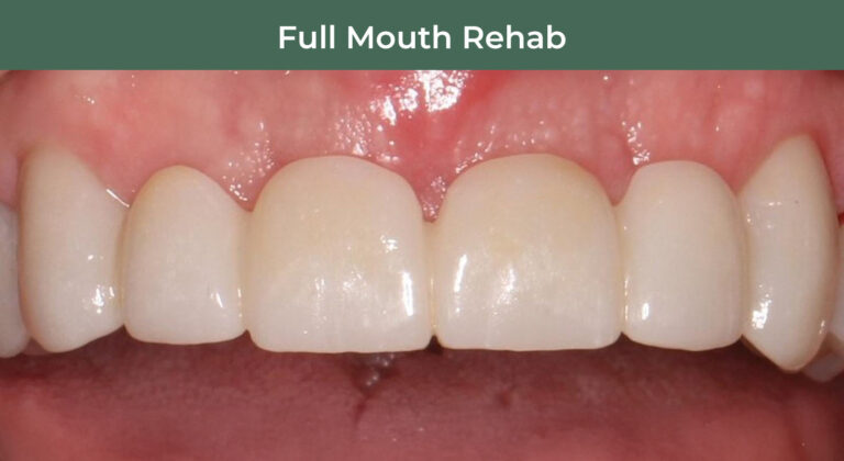 After full-mouth rehabilitation at Manson & Chi Dentistry in Kirkland, WA