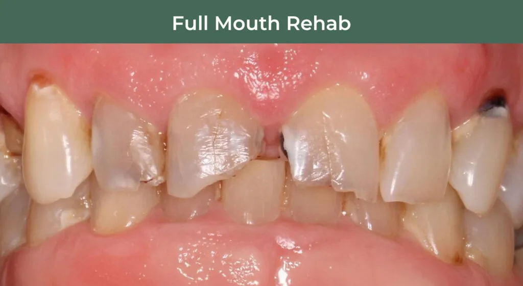 Before full-mouth rehabilitation at Manson & Chi Dentistry in Kirkland, WA