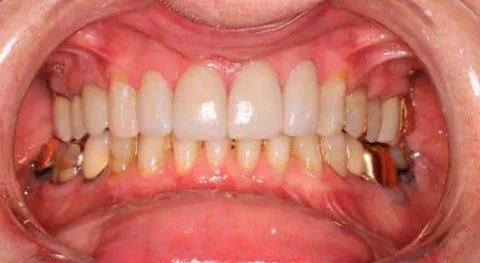 After anterior dental crowns in Kirkland, WA, at Manson & Chi Dentistry