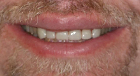 After dental crowns in Kirkland, WA, at Manson & Chi Dentistry