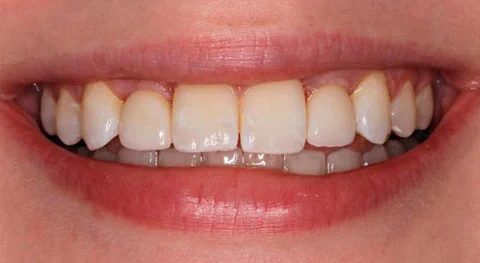 After dental implants in Kirkland, WA, at Manson & Chi Dentistry