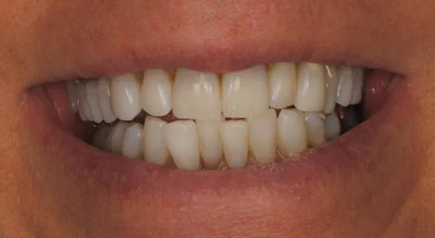 After KOR Teeth Whitening in Kirkland, WA, at Mason & Chi Dentistry