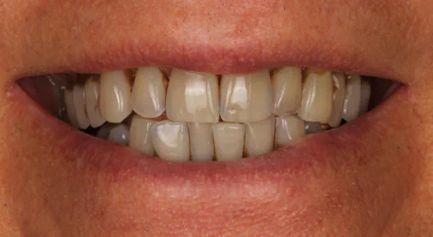 Before KOR Teeth Whitening in Kirkland, WA, at Mason & Chi Dentistry