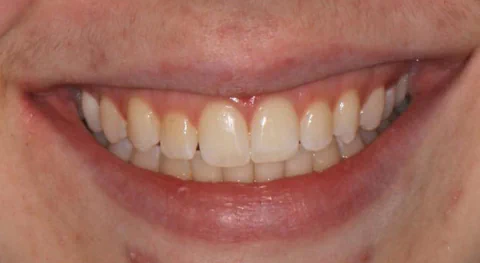 After Clear Aligner Treatment in Kirkland, WA, at Manson & Chi Dentistry