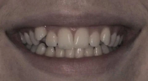 Before Clear Aligner Treatment in Kirkland, WA, at Manson & Chi Dentistry