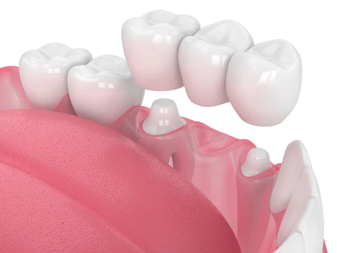 Dental Crowns and Bridges